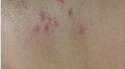 Identifying bed bug bites – PestHQ