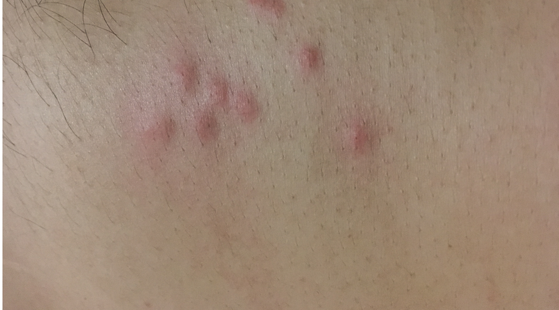 Identifying bed bug bites